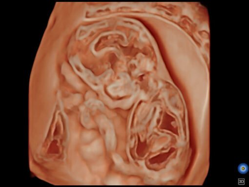 SonoScape P50 Elite pour cardiologie