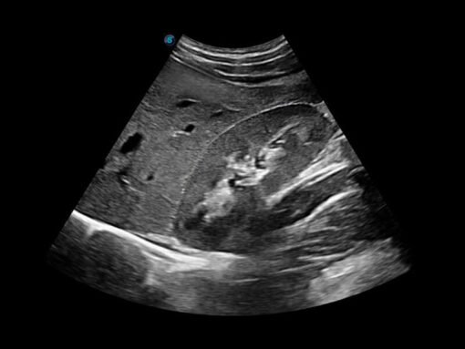 SonoScape P50 Elite pour radiologie