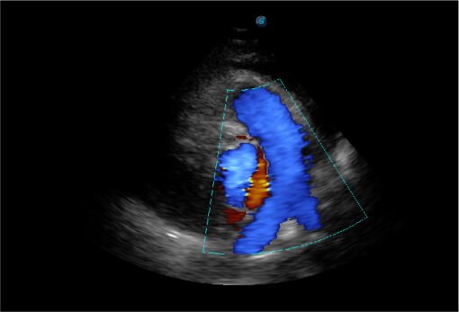 SonoScape P15 en utilisation clinique